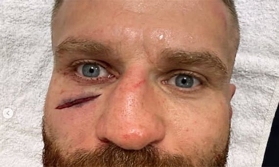 Ян Блахович показал жуткое рассечение после поражения на UFC в Белграде