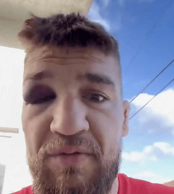 Ярослав Амосов раскрыл детали травмы перед UFC 328: огромный синяк под глазом за две недели до боя
